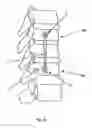Fig. 11 - Fixation device for bones