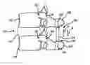 Fig. 01 - Spinal stabilization