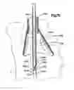 Fig. 33 - Minimally invasive access device and method
