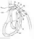 Fig. 01 - Double loop gastric bypass procedure