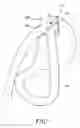 Fig. 02 - Double loop gastric bypass procedure