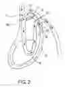 Fig. 03 - Double loop gastric bypass procedure
