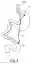 Fig. 04 - Double loop gastric bypass procedure
