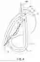 Fig. 05 - Double loop gastric bypass procedure