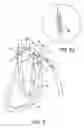 Fig. 06 - Double loop gastric bypass procedure