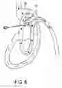 Fig. 07 - Double loop gastric bypass procedure