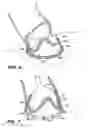 Fig. 11 - Apparatus and methods for valve repair