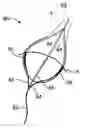 Fig. 01 - Methods and apparatus to achieve a closure of a layered tissue defect