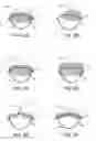 Fig. 06 - Methods and apparatus to achieve a closure of a layered tissue defect