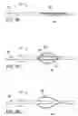 Fig. 09 - Methods and apparatus to achieve a closure of a layered tissue defect