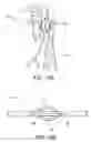 Fig. 10 - Methods and apparatus to achieve a closure of a layered tissue defect