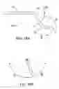 Fig. 17 - Methods and apparatus to achieve a closure of a layered tissue defect