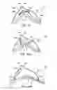 Fig. 31 - Methods and apparatus to achieve a closure of a layered tissue defect