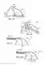 Fig. 32 - Methods and apparatus to achieve a closure of a layered tissue defect