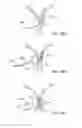 Fig. 34 - Methods and apparatus to achieve a closure of a layered tissue defect