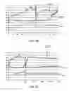 Fig. 52 - Methods and apparatus to achieve a closure of a layered tissue defect