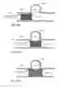 Fig. 17 - Vessel treatment devices