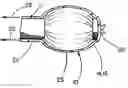 Fig. 01 - Balloon catheter device