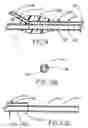 Fig. 07 - Balloon catheter device
