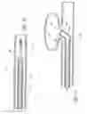 Fig. 06 - Intracorporeal occlusive device and method