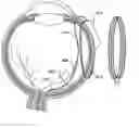 Fig. 01 - Retinal prosthesis