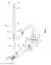 Fig. 02 - In situ stent formation
