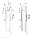 Fig. 08 - In situ stent formation
