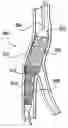 Fig. 01 - Catheter system for stenting bifurcated vessels