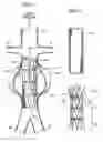 Fig. 02 - Endoluminal vascular prosthesis