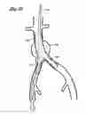 Fig. 28 - Implantable vascular graft