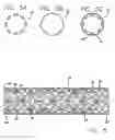 Fig. 05 - Drug-eluting stent cover method of use