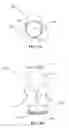 Fig. 03 - Vascular prosthesis