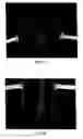 Fig. 04 - Vascular prosthesis