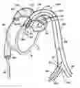 Fig. 01 - Method and apparatus for implanting an aortic valve prosthesis