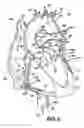 Fig. 03 - Method and apparatus for implanting an aortic valve prosthesis