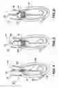 Fig. 04 - Method and apparatus for implanting an aortic valve prosthesis