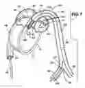 Fig. 05 - Method and apparatus for implanting an aortic valve prosthesis
