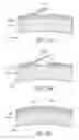 Fig. 17 - Masked intraocular devices