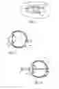 Fig. 02 - Method of making an ocular implant