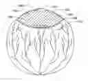 Fig. 01 - Multilens intraocular lens system with injectable accommodation material