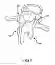 Fig. 02 - Facet replacement