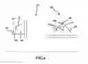 Fig. 04 - Facet replacement