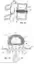 Fig. 03 - Spinal disc annulus augmentation