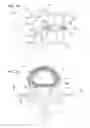 Fig. 02 - Spinal disc annulus augmentation