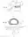 Fig. 03 - Spinal disc annulus augmentation
