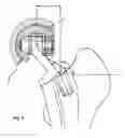 Fig. 06 - Hip prosthesis and the use thereof