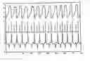 Fig. 01 - Method and apparatus for detecting the respiratory activity of a person
