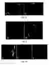 Fig. 05 - Magnetic resonance imaging having radiation compatible radiofrequency coils