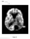 Fig. 06 - Inverse planning using optimization constraints derived from image intensity