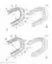 Fig. 02 - Orthodontic appliance with embedded wire for moving teeth and method